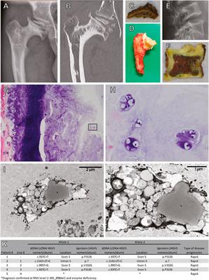 Modeling cartilage pathology in mucopolysaccharidosis VI using iPSCs reveals early dysregulation of chondrogenic and metabolic gene expression